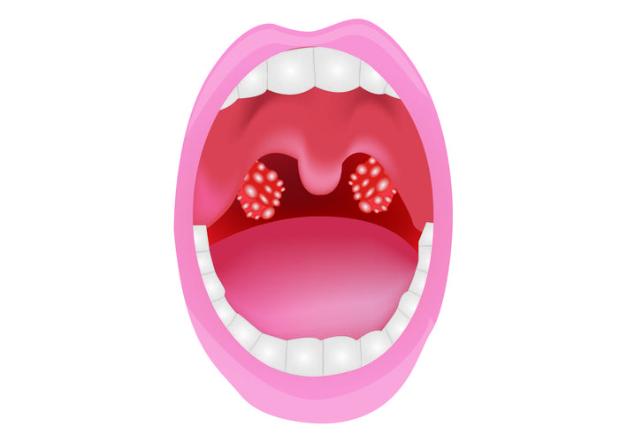 Adult Tonsillitis: Causes, Symptoms and Treatment