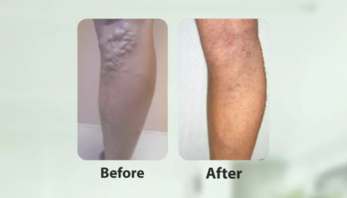 Varicose veins: Causes, treatment, diagnosis, and prevention