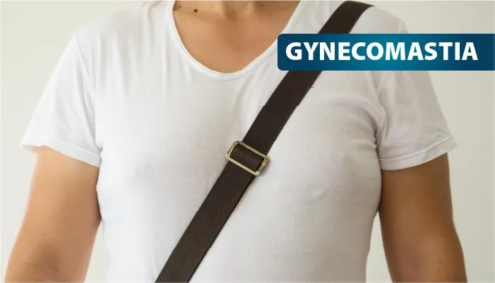 Gynecomastia