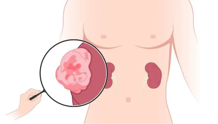 Pyeloplasty
