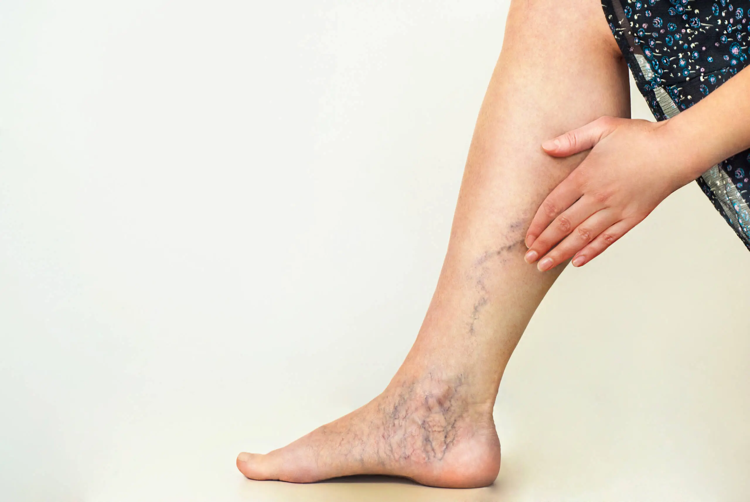 Treat Varicose Without Surgery and Walk Home Without Hospital Stay!