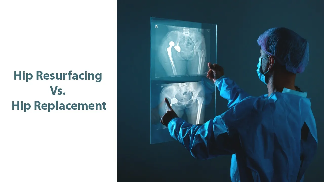 Hip Resurfacing Vs. Hip Replacement: Which Is Right for You?