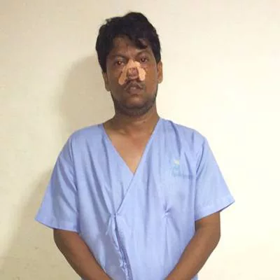 Jitender Kumar had Nose Surgery